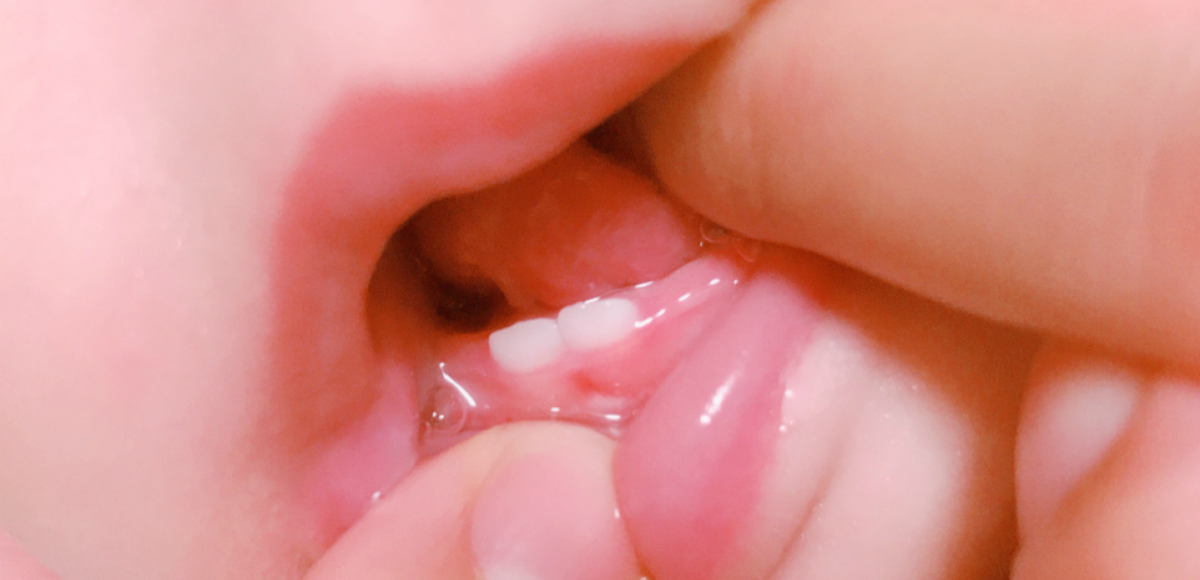 生えてきたばかりの下前歯の乳歯
